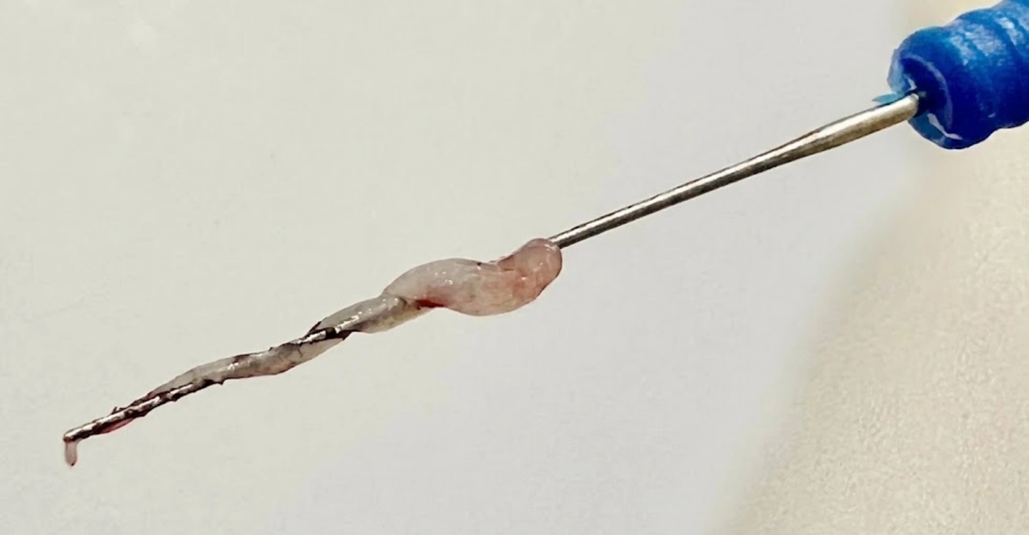 Dental Pulp Inblog